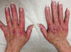 Pruritic rash on hands of patient that started 2 weeks into treatment with simeprevir plus sofosbuvir. The photograph is taken 10 weeks into treatment. The rash only manifested in sun exposed areas.