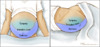To perform the shifting dullness test, have the individual move to a supine position, then percuss the entire abdominal region, and mark the dullness-tympany transition point (left figure). Then place the person in the right lateral decubitus position, wait 30 to 60 seconds, repeat the percussion, and again mark the dullness-tympany transition point (right figure). A positive shifting dullness test is indicated by a shifting of the transition point.