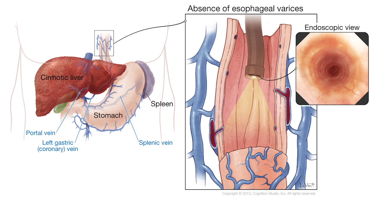 esophageal varices grading