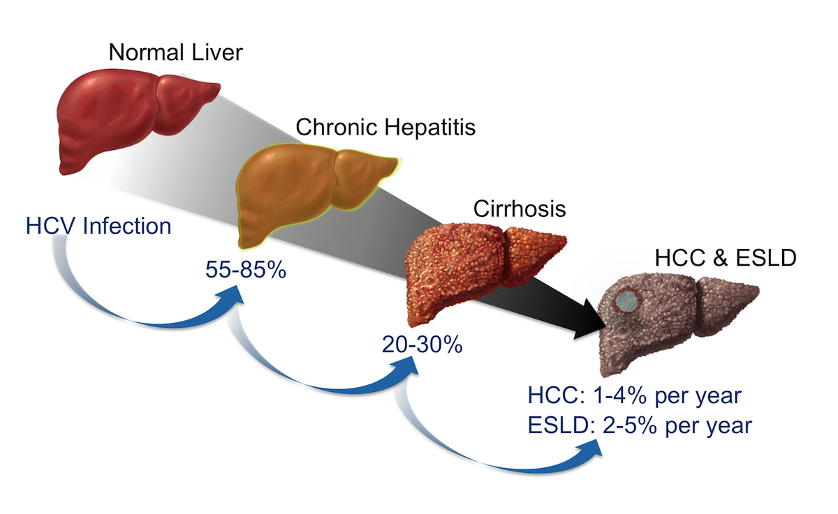 Вирусный hcv. Гепатит c. Стадии гепатита.