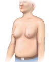 In men with cirrhosis, benign enlargement of the breasts may occur and manifest as gynecomastia.